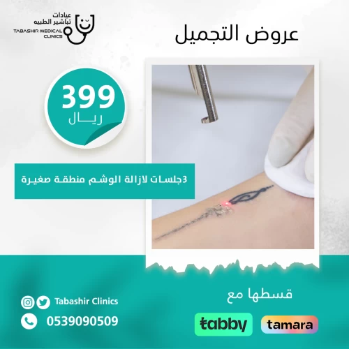 3 جلسات ليزر إزالة الوشم منطقة صغيرة