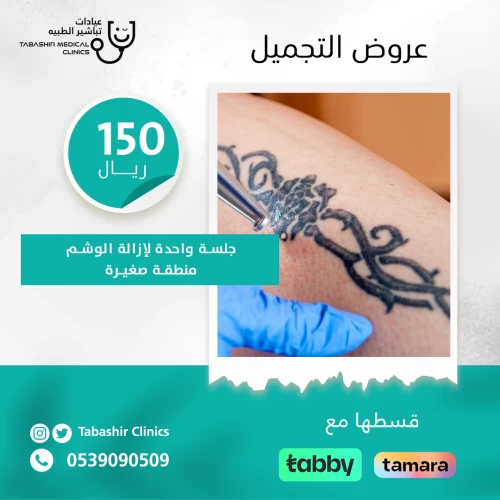 إزالة الوشم منطقة صغيرة