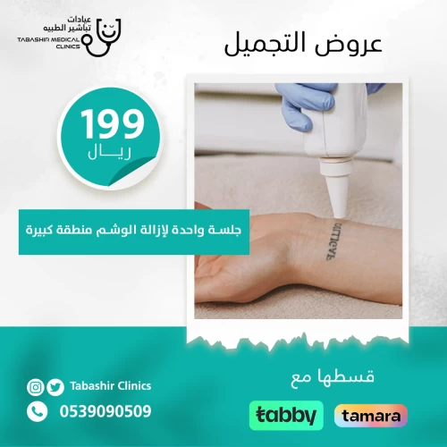 إزالة الوشم منطقة كبيرة