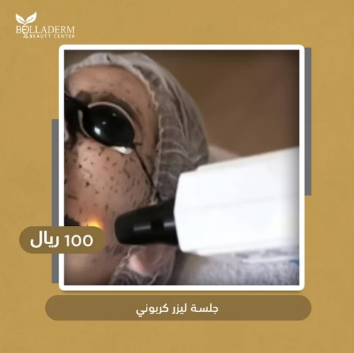 جلسة ليزر كربوني